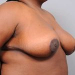 Breast Reduction Before & After Patient #1308