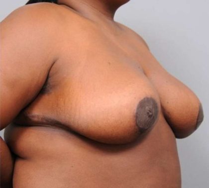 Breast Reduction Before & After Patient #1308