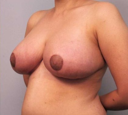 Breast Reduction Before & After Patient #1338