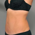 Tummy Tuck Before & After Patient #338
