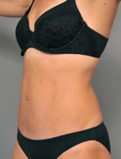 Tummy Tuck Before & After Patient #338