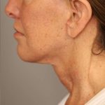Facelift Before & After Patient #1359