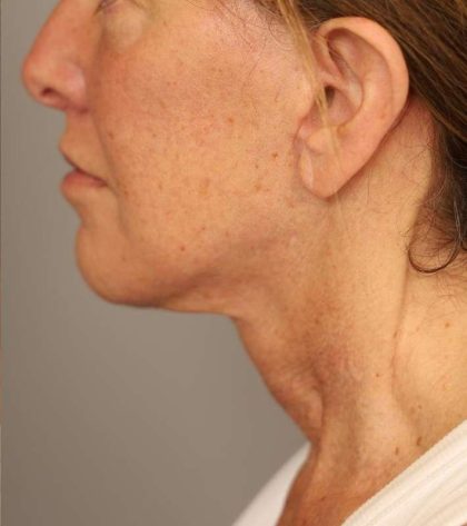 Facelift Before & After Patient #1359