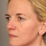Facelift Before & After Patient #1371