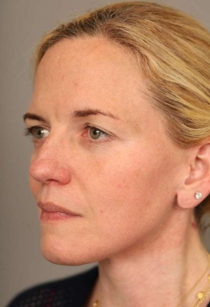 Facelift Before & After Patient #1371