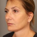 Facelift Before & After Patient #1380