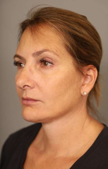 Facelift Before & After Patient #1380
