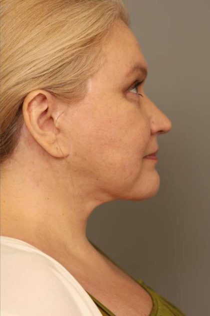 Facelift Before & After Patient #1389