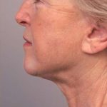 Facelift Before & After Patient #1404