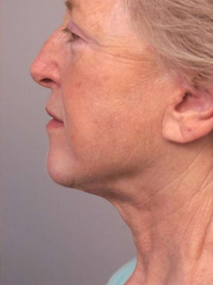 Facelift Before & After Patient #1404