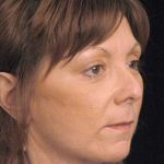 Facelift Before & After Patient #1411