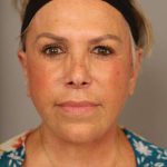 Facelift Before & After Patient #1418