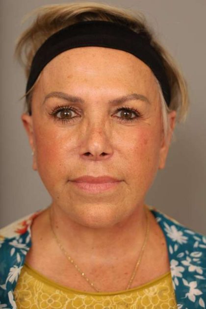 Facelift Before & After Patient #1418