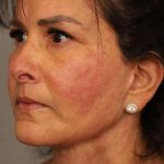 Facelift Before & After Patient #1427