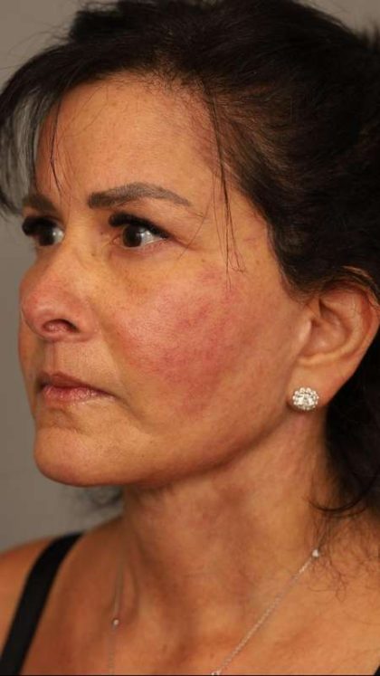Facelift Before & After Patient #1427