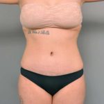 Tummy Tuck Before & After Patient #345