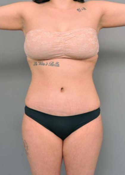 Tummy Tuck Before & After Patient #345