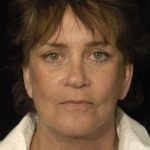 Facelift Before & After Patient #1443