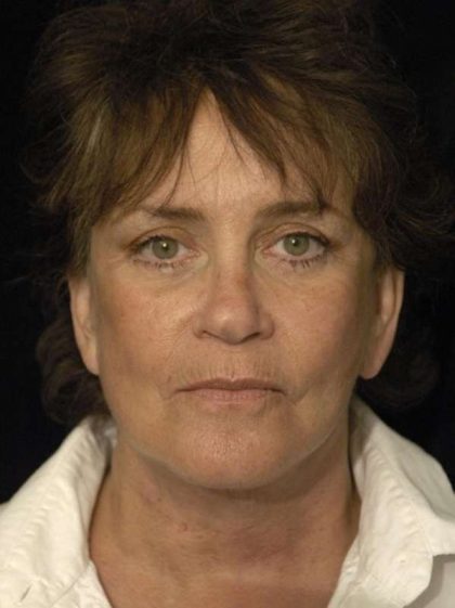 Facelift Before & After Patient #1443