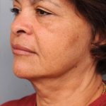 Naturalift&trade; Mini Facelift Before & After Patient #1452