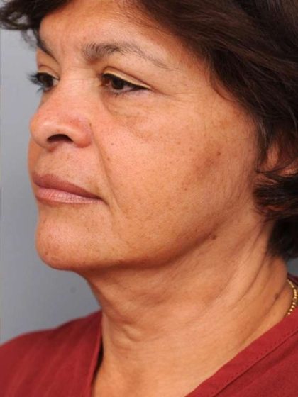 Naturalift™ Mini Facelift Before & After Patient #1452
