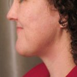 Naturalift&trade; Mini Facelift Before & After Patient #1457