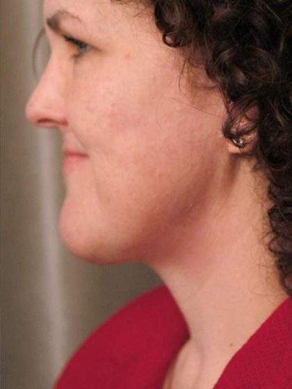 Naturalift™ Mini Facelift Before & After Patient #1457