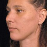 Naturalift&trade; Mini Facelift Before & After Patient #1464