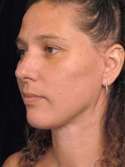 Naturalift™ Mini Facelift Before & After Patient #1464