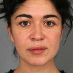 Naturalift&trade; Mini Facelift Before & After Patient #1474