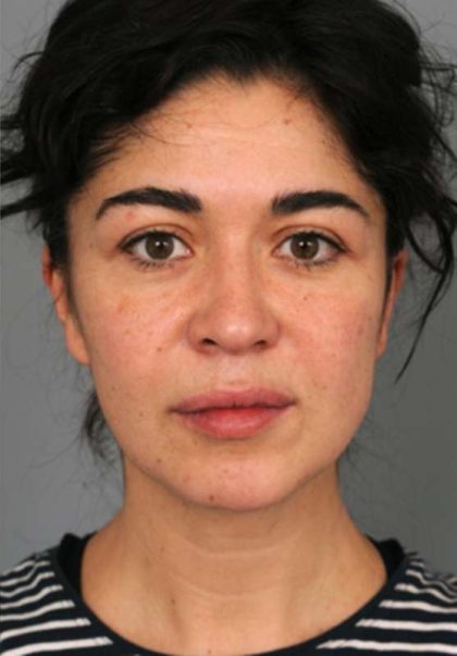 Naturalift™ Mini Facelift Before & After Patient #1474