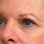Eyelid Surgery Before & After Patient #1481
