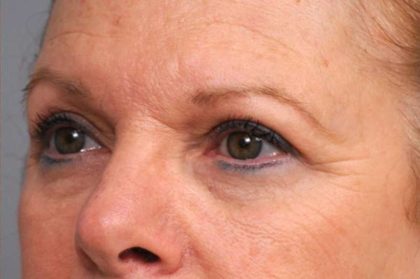 Eyelid Surgery Before & After Patient #1481
