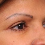 Eyelid Surgery Before & After Patient #1490
