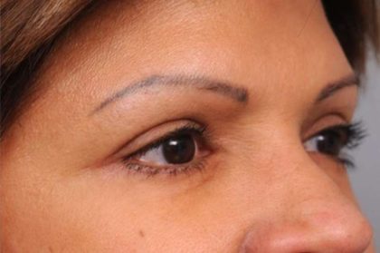 Eyelid Surgery Before & After Patient #1490