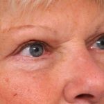 Eyelid Surgery Before & After Patient #1504