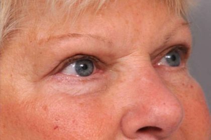 Eyelid Surgery Before & After Patient #1504