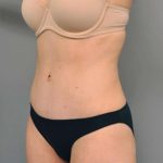 Tummy Tuck Before & After Patient #354