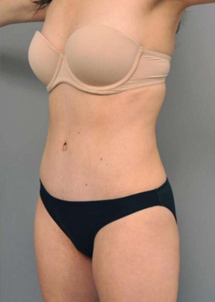 Tummy Tuck Before & After Patient #354