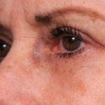 Eyelid Surgery Before & After Patient #1509