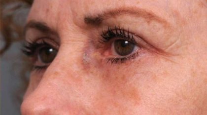 Eyelid Surgery Before & After Patient #1509