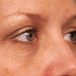 Eyelid Surgery Before & After Patient #1514