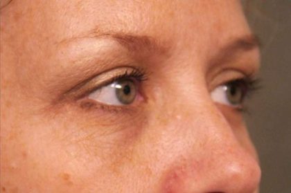 Eyelid Surgery Before & After Patient #1514