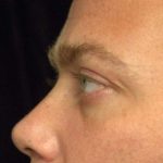 Eyelid Surgery Before & After Patient #1519