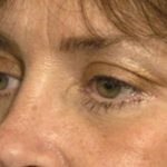Eyelid Surgery Before & After Patient #1525