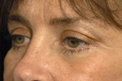 Eyelid Surgery Before & After Patient #1525