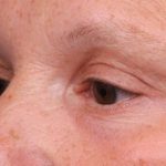 Eyelid Surgery Before & After Patient #1530
