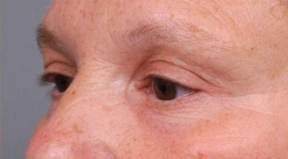 Eyelid Surgery Before & After Patient #1530
