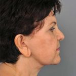 Eyelid Surgery Before & After Patient #1540