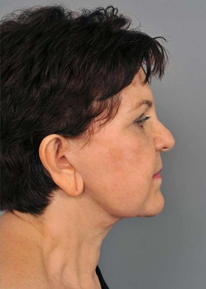 Eyelid Surgery Before & After Patient #1540